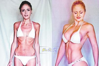瑞典23岁的少女Strmberg曾经因减肥减到患厌食症，整个人骨瘦如柴形如枯蒿，而如今Strmberg摇身一变成了一个身材火辣的健身达人。