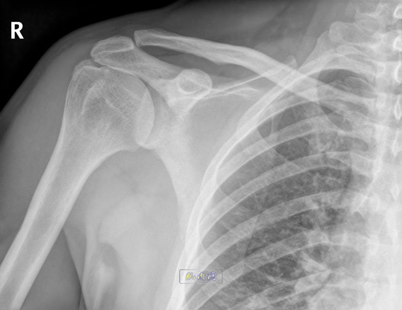 Shoulder-Joint-X-Ray
